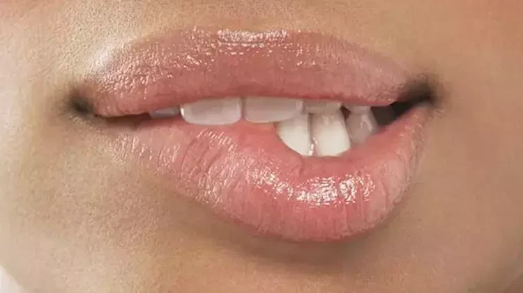 lip lift nasıl yapılır milliyet pembenar