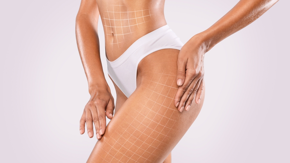 Vaser Liposuction 1